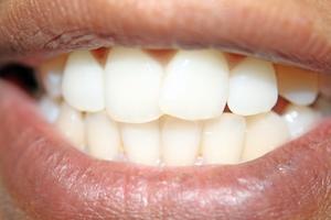 Indstillinger for manglende tænder