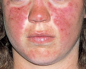 Hvad er de behandlinger af Lupus hudirritation?