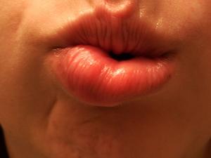 Læbe hævet forkølelsessår (herpes)