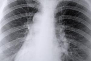 Årsager til Lung ardannelse