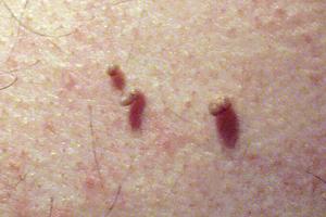 Hvad er de behandlinger af huden tags?